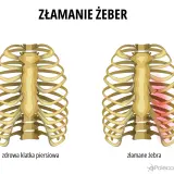 Porównanie zdrowej klatki piersiowej i złamanych żeber. Złamane żebro wymaga odpowiedniego leczenia i rehabilitacji.