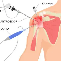 Ilustracja przedstawia artroskopię barku: kamerę, artroskop, golarkę i kaniulę w stawie.