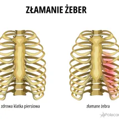 Porównanie zdrowej klatki piersiowej i złamanych żeber. Złamane żebro wymaga odpowiedniego leczenia i rehabilitacji.