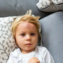 Mały chłopiec z blond włosami leży na kanapie z widocznym guzem na czole po mocnym uderzeniu w głowę.