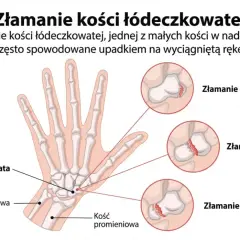Ilustracja pokazuje złamanie kości łódeczkowatej nadgarstka, co może być podstawą do ubiegania się o odszkodowanie.