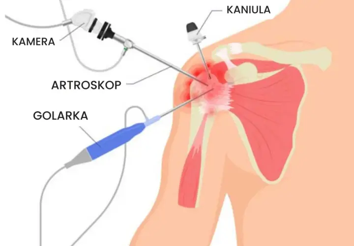Ilustracja przedstawia artroskopię barku: kamerę, artroskop, golarkę i kaniulę w stawie.