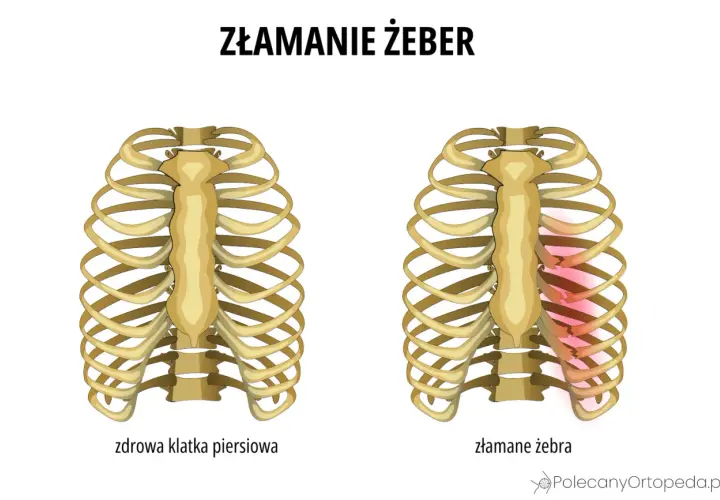 Porównanie zdrowej klatki piersiowej i złamanych żeber. Złamane żebro wymaga odpowiedniego leczenia i rehabilitacji.