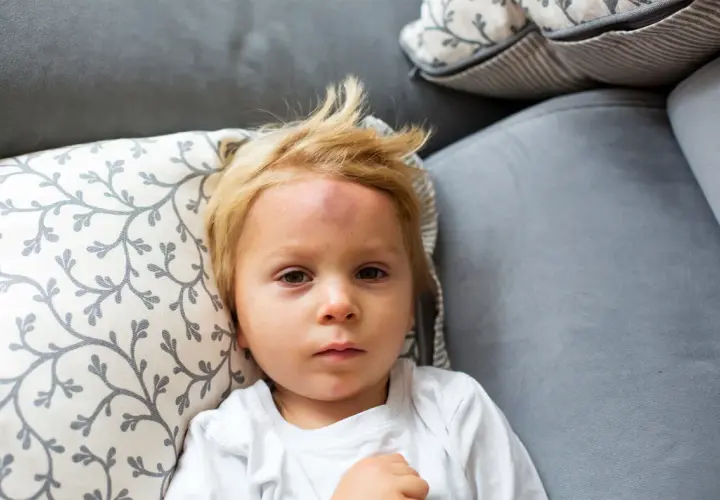 Mały chłopiec z blond włosami leży na kanapie z widocznym guzem na czole po mocnym uderzeniu w głowę.