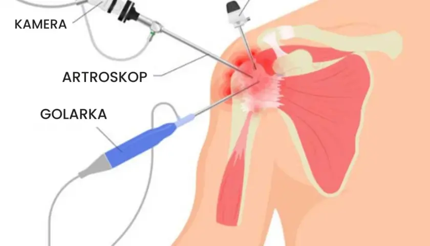 Ilustracja przedstawia artroskopię barku: kamerę, artroskop, golarkę i kaniulę w stawie.