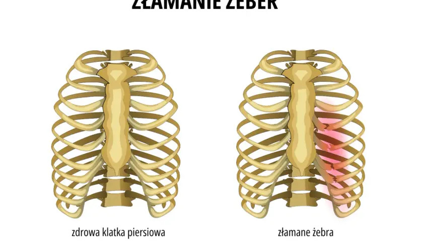 Porównanie zdrowej klatki piersiowej i złamanych żeber. Złamane żebro wymaga odpowiedniego leczenia i rehabilitacji.