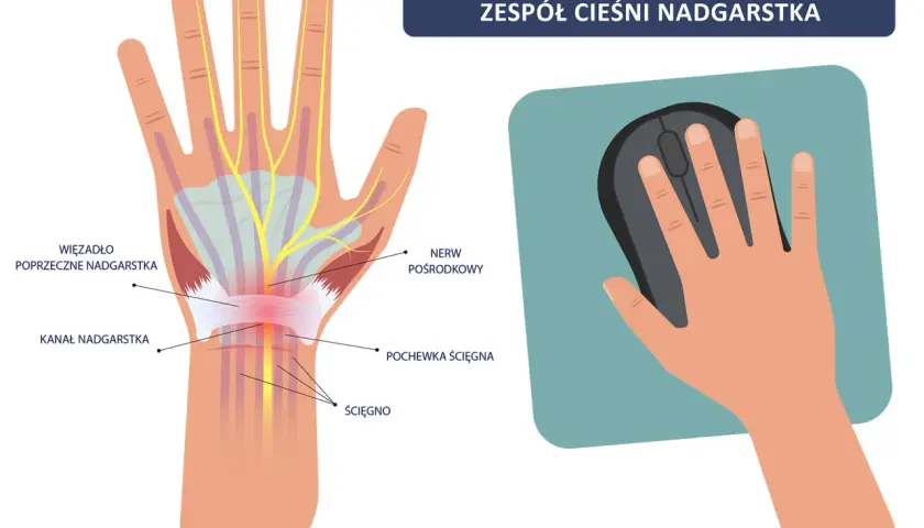 Anatomia cieśni nadgarstka i dłoń trzymająca myszkę. Ilustracja pokazuje ucisk na nerw pośrodkowy, który może prowadzić do bólu i drętwienia, a także do konieczności ubiegania się o odszkodowanie po operacji cieśni nadgarstka.