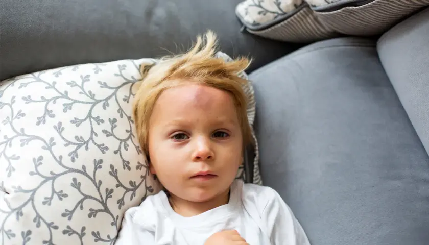 Mały chłopiec z blond włosami leży na kanapie z widocznym guzem na czole po mocnym uderzeniu w głowę.