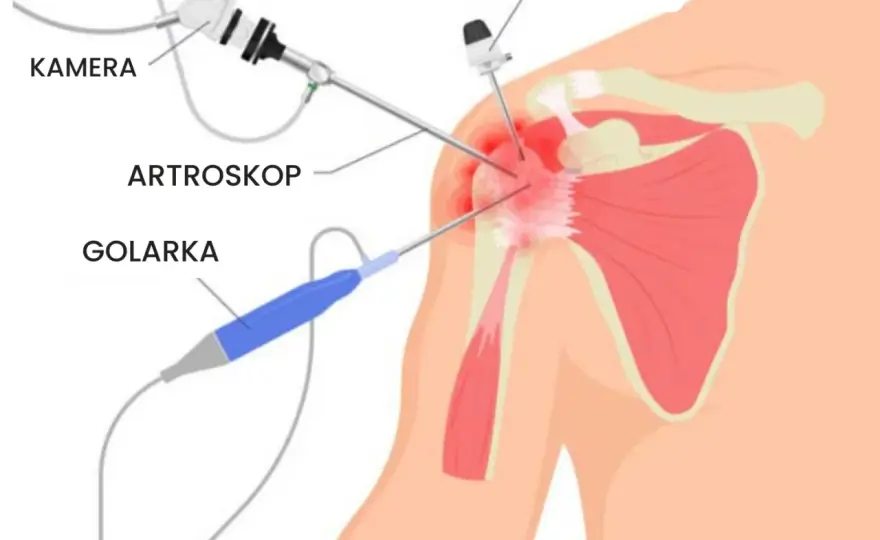 Renta po artroskopii barku - Jak skutecznie złożyć wniosek?