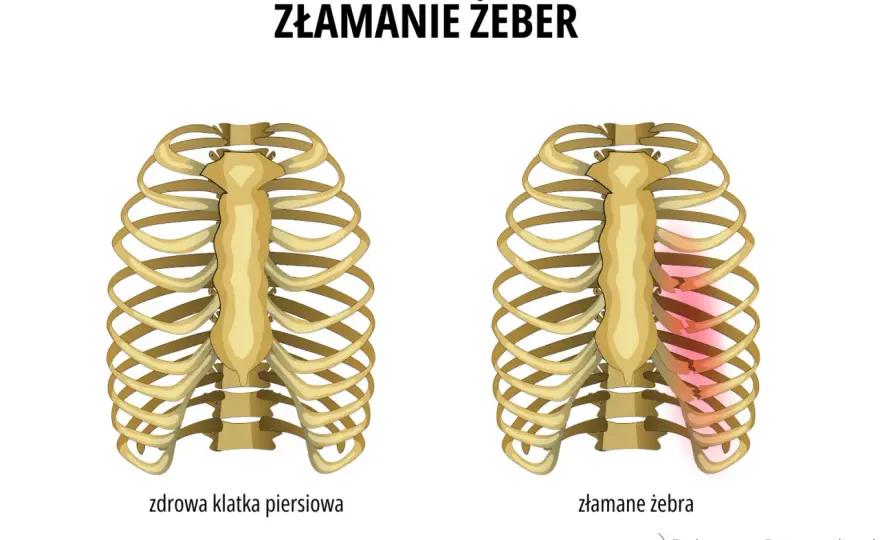 Złamane żebro - Ile trwa zwolnienie i kiedy wrócisz do pracy?