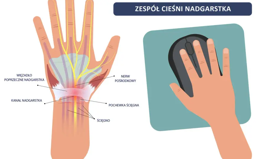 Odszkodowanie po cieśni nadgarstka - Jak je uzyskać?