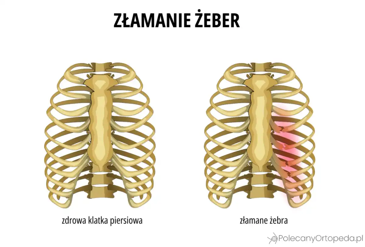 Złamane żebro - Ile trwa zwolnienie i kiedy wrócisz do pracy?
