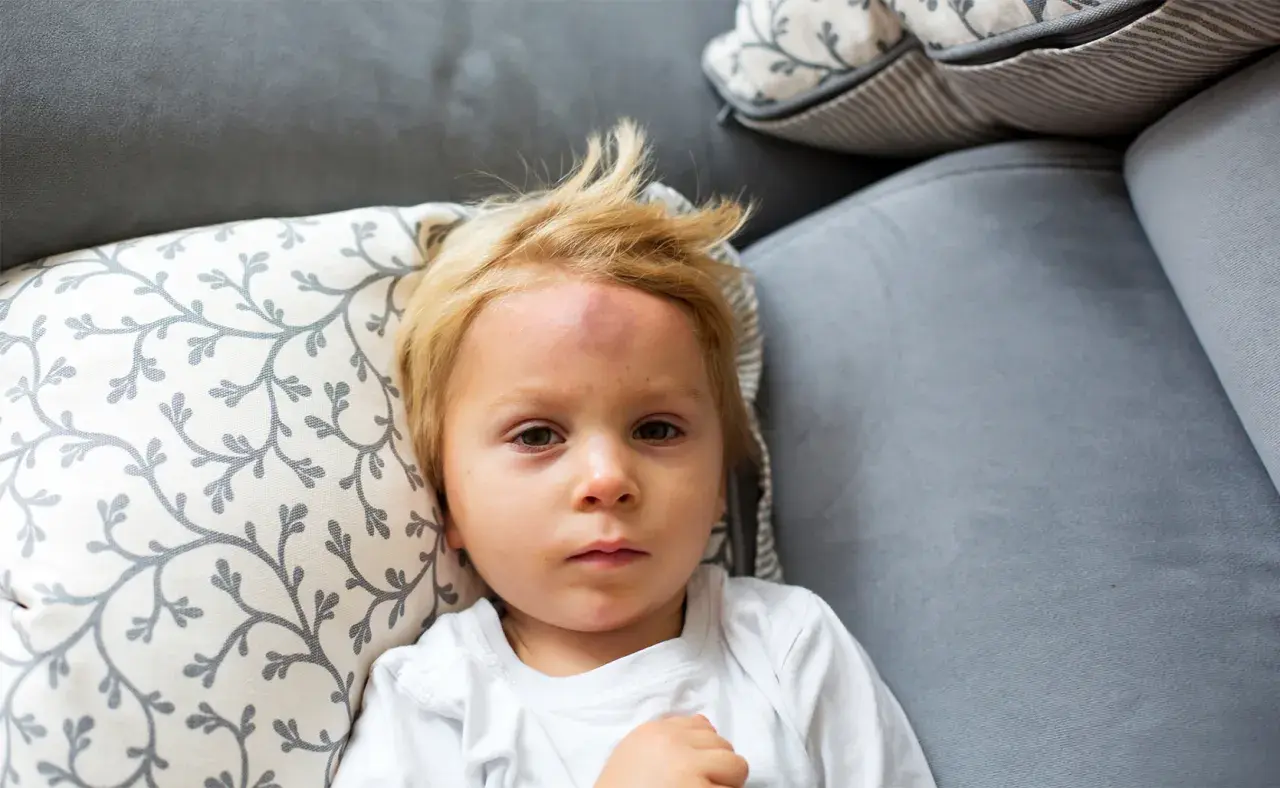 Mały chłopiec z blond włosami leży na kanapie z widocznym guzem na czole po mocnym uderzeniu w głowę.