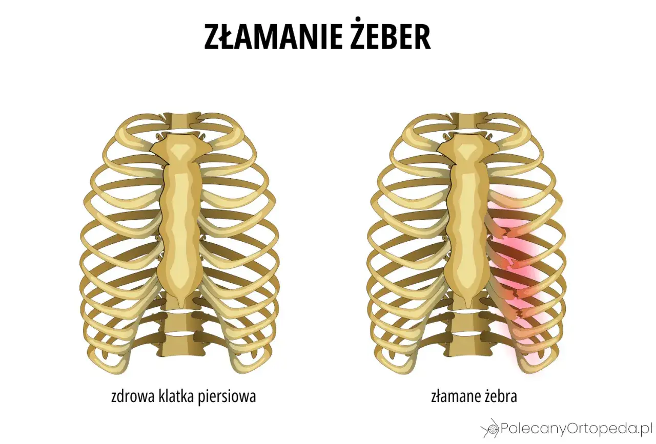Porównanie zdrowej klatki piersiowej z klatką ze złamanymi żebrami. Złamane żebro wymaga odpowiedniego leczenia.