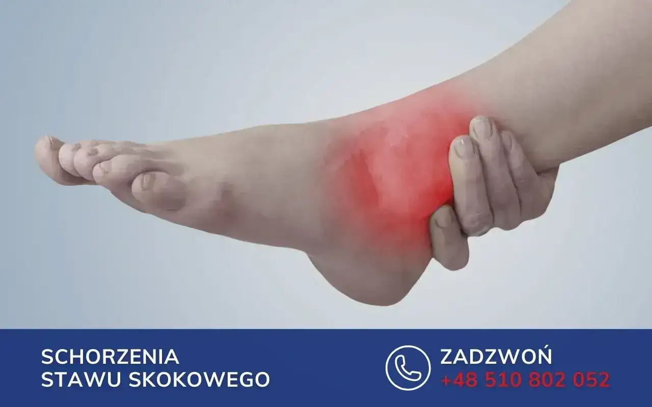 Ból stawu skokowego, kod choroby s90. Możliwe odszkodowanie. Zadzwoń po pomoc.