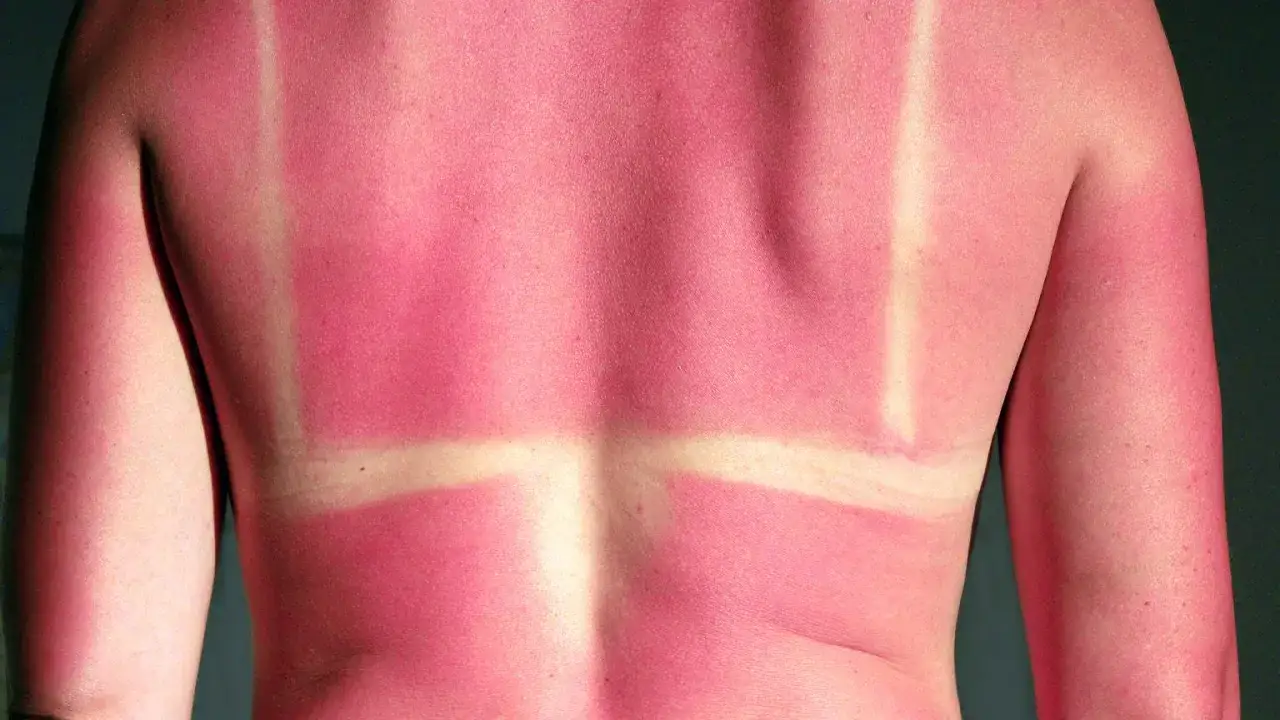 Oparzenie po solarium na plecach, widoczne jasne pasy od stroju kąpielowego na zaczerwienionej skórze.